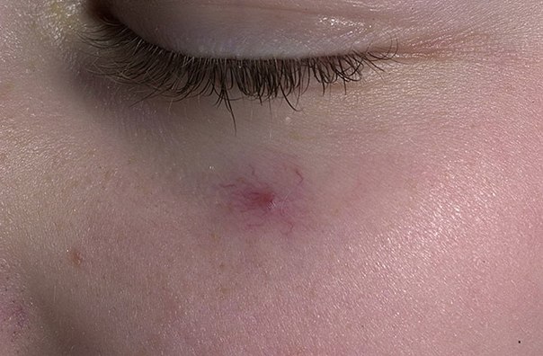 купероз на щеке