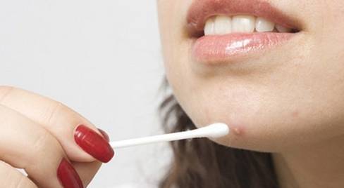 прижечь прыщ перекисью водорода