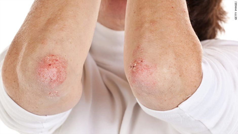 profilaktika psoriaza narodnymi sredstvami foto