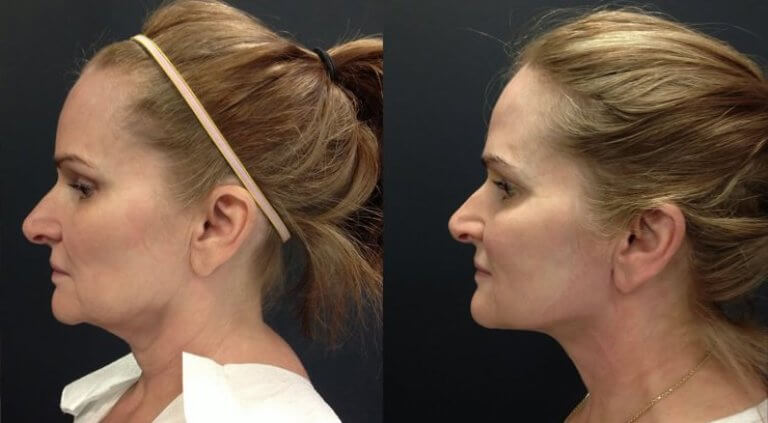 Фото до и после подтяжки шеи