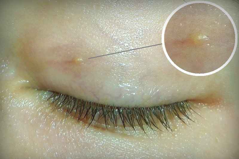 Появилась просянка на веке, как избавиться от проблемы