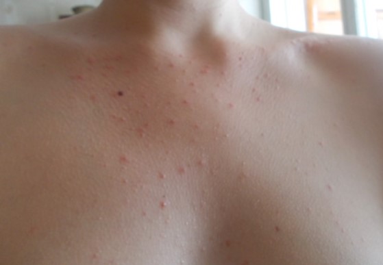Какая причина прыщей на грудине у женщин