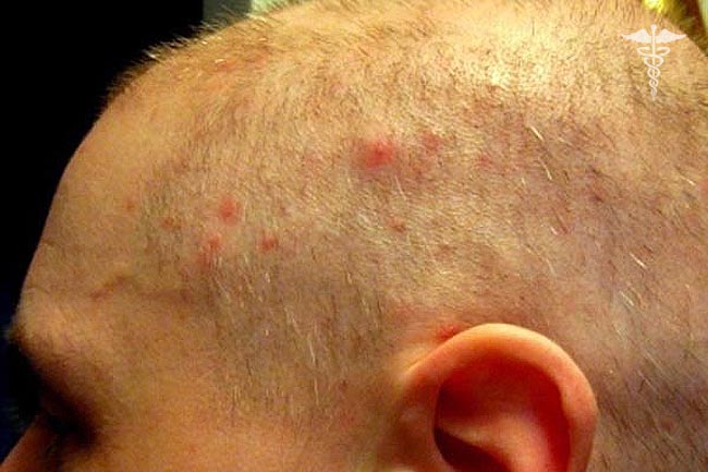 Почему появляются прыщи на голове