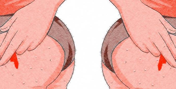 прыщи на ягодицах