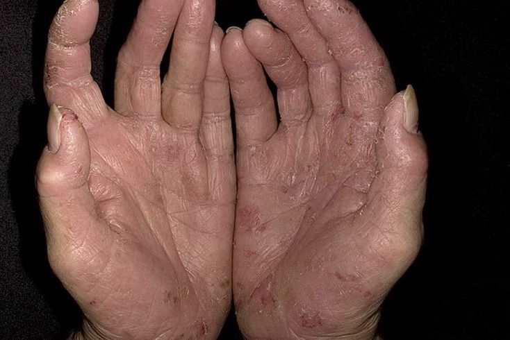псориаз на ладонях