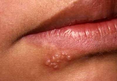 пузырьковый лишай фото