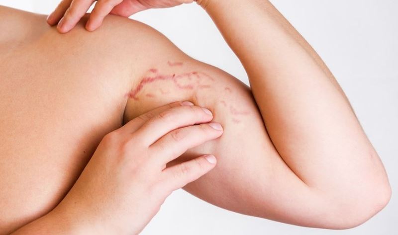 Растяжки у мужчин на руке