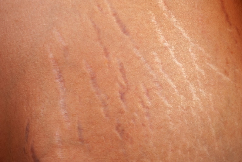 Растяжки у мужчин на теле