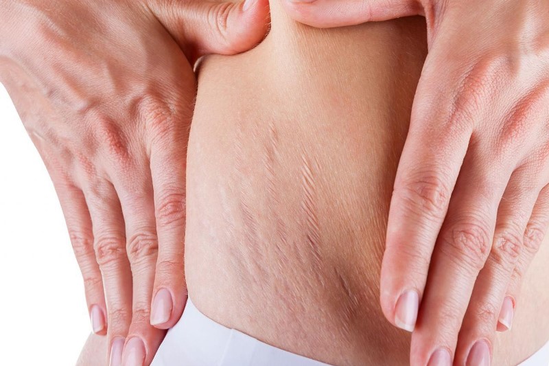 Растяжки на коже у девушки