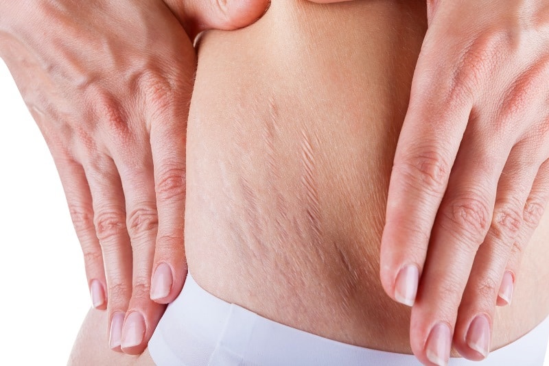 Растяжки на теле у девушки