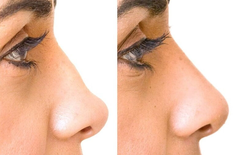 Фото до и после безоперационной ринопластики