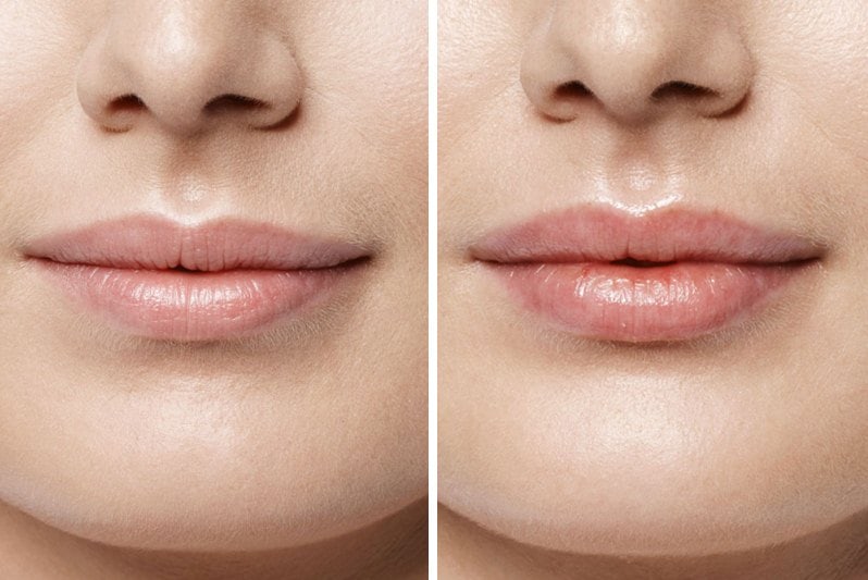 губы до и после