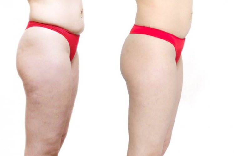 до и после РФ лифтинга тела