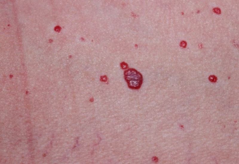 Красные родинки на теле