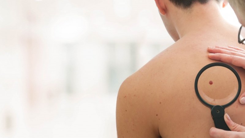 Диагностика родинки