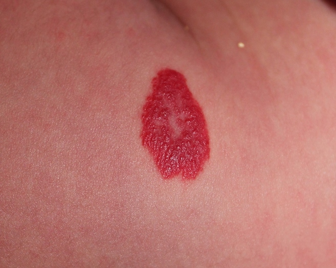 Красные родинки на теле, причины возникновения