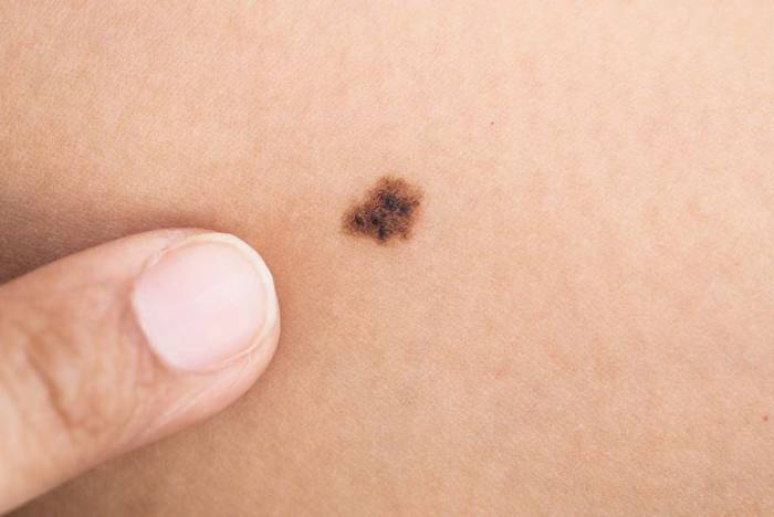 Родинка вблизи