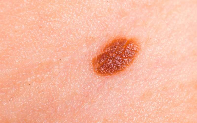 Родинка на коже