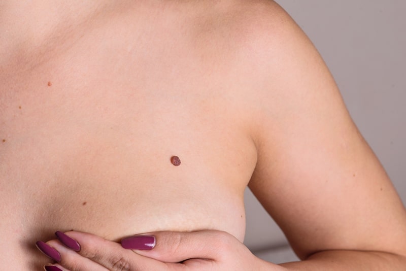 Родинки во время беременности над грудью