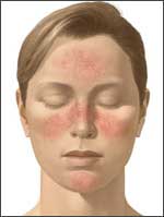 rosacea