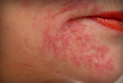 Прыщи вокруг рта - какая их причина и способы лечение