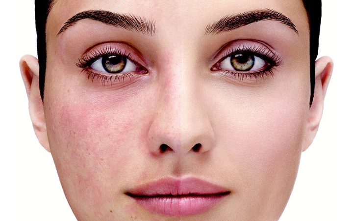 rozacea-chto-eto-takoe