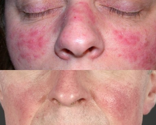 rozacea-foto-do-i-posle-lecheniya