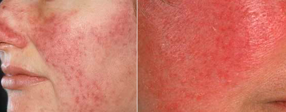 rozacea-foto-do-i-posle