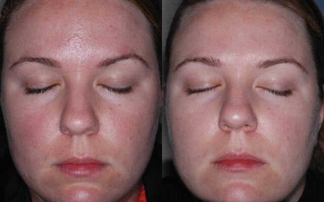 rozacea-na-lice-lechenie