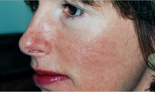 rozacea