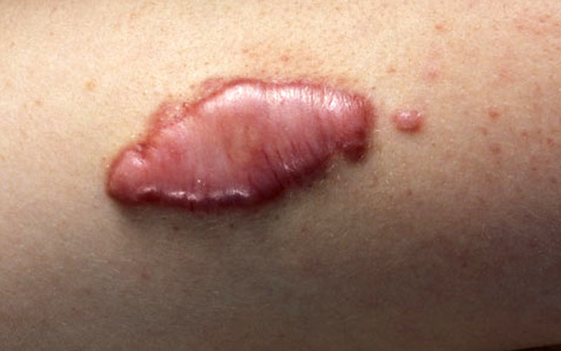 Келоидный рубец: фото симптоматики