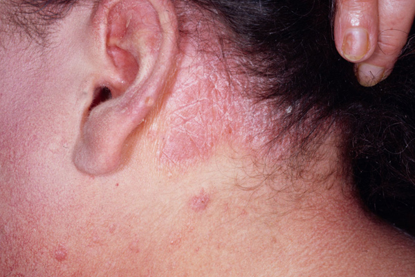 psoriaz-foto