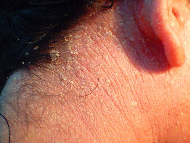 Кожный дерматит и все про него