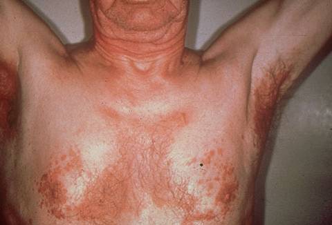 себорейная экзема фото