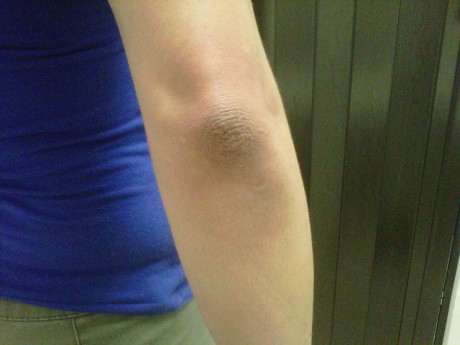 шелушение кожи на локтях