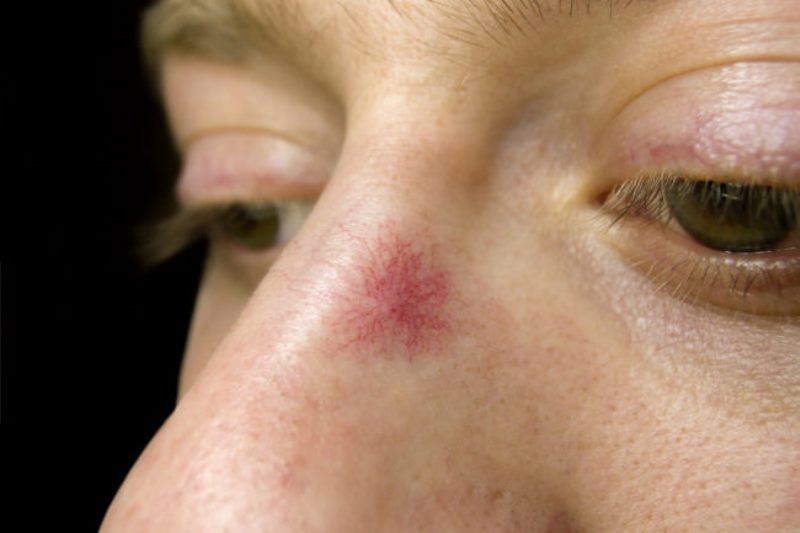 Капилляры на носу