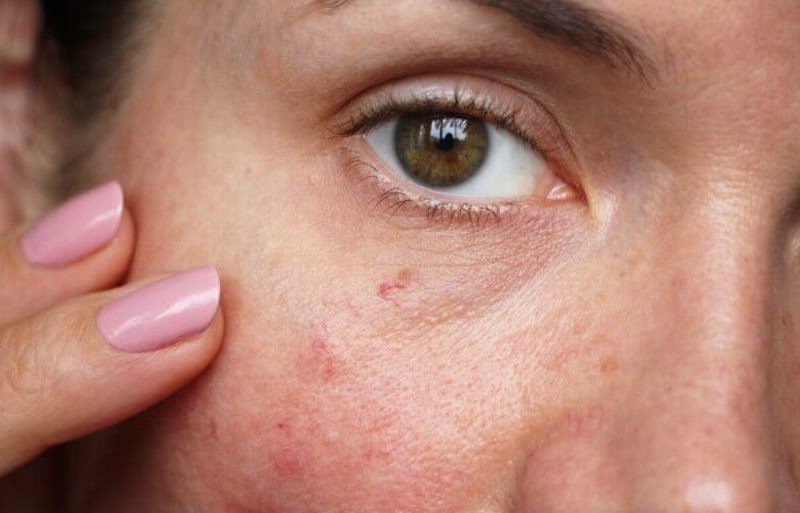 Капилляры на лице возле глаза