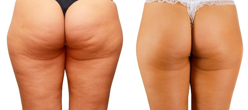 Фото до и после прессотерапии