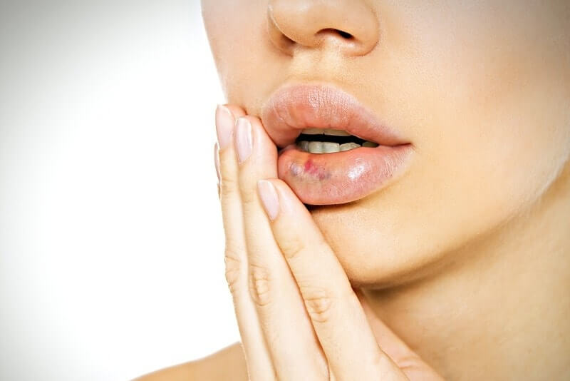 Отек после увеличения губ