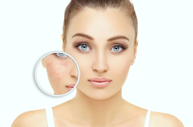 Показания к энзимному пилингу