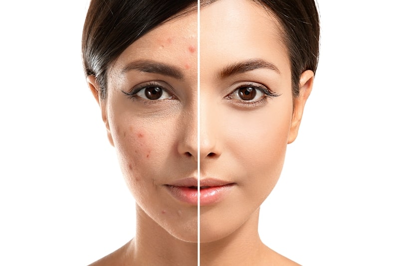 Половина лица чистая и половина с прыщами