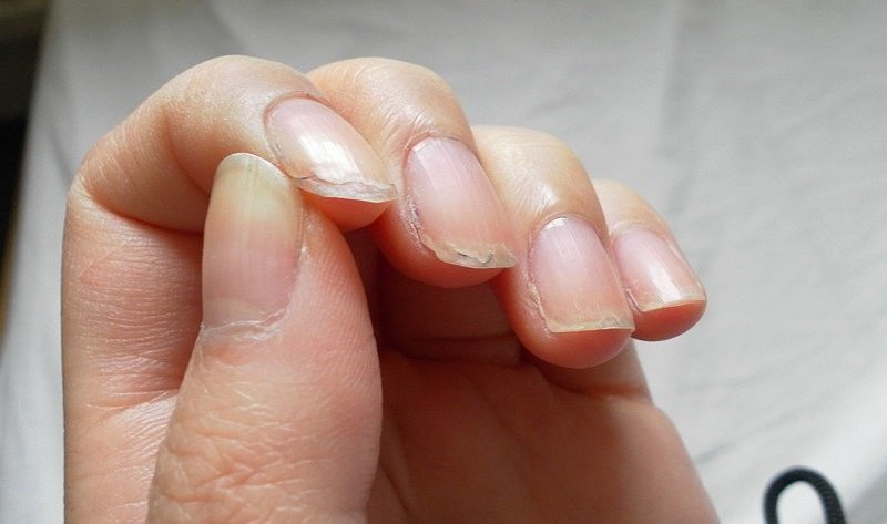 Слоятся ногти на руках