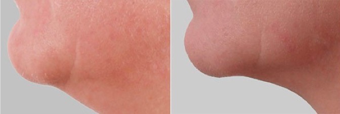 безоперационная подтяжка подбородка фото до и после как подтянуть подбородок