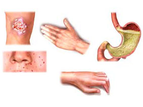 solyariya pri psoriaze