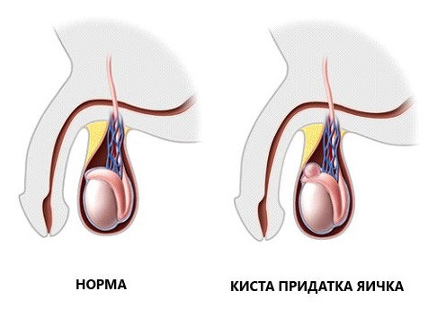 Киста семенного канатика у мальчиков
