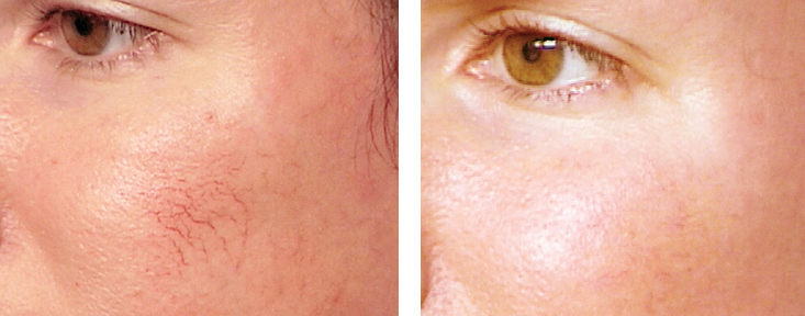 сосудистая сеточка на щеке и нет