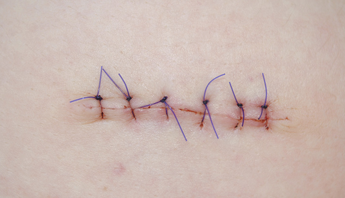 шов послеоперационный