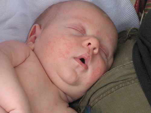 syp-na-shhekax-u-novorozhdennogo-foto