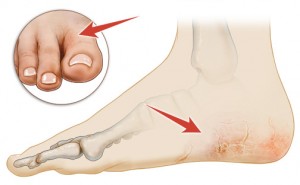 treskaetsya-kozha-na-pyatkax