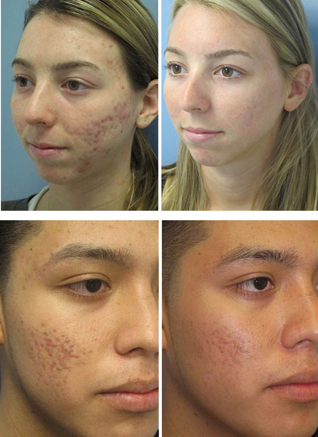 Как можно быстро залечить рану от прыща